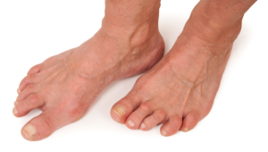 Rheumatoid arthritis Treatment