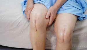 Total knee replacement
