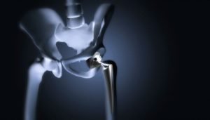 How long does partial hip replacement operation take
