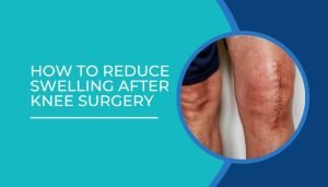 Swelling after knee surgery
