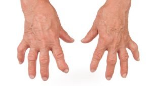 Rheumatoid arthritis symptoms
