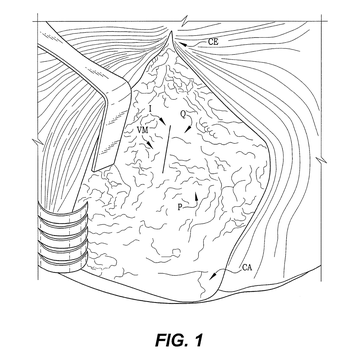 US 10,149,774 B1 figure