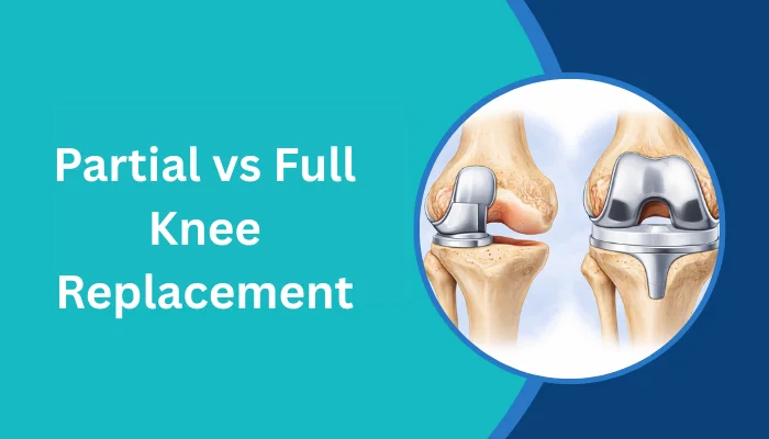 Partial vs Full Knee Replacement