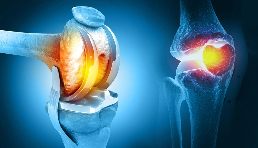 Knee Replacement Surgeon 1 1